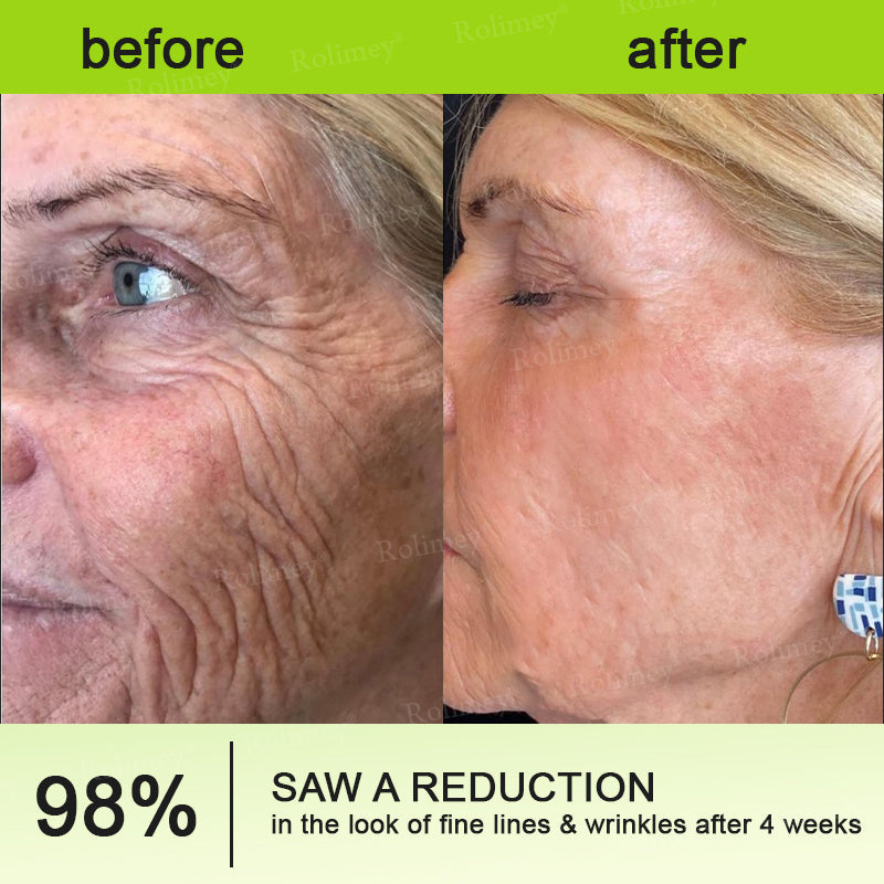 🔥Final 3 Hours: 70%OFF🔥 Botulinum & Vita-A Retinol Shot Wrinkle-Lift Tightening cream✨
