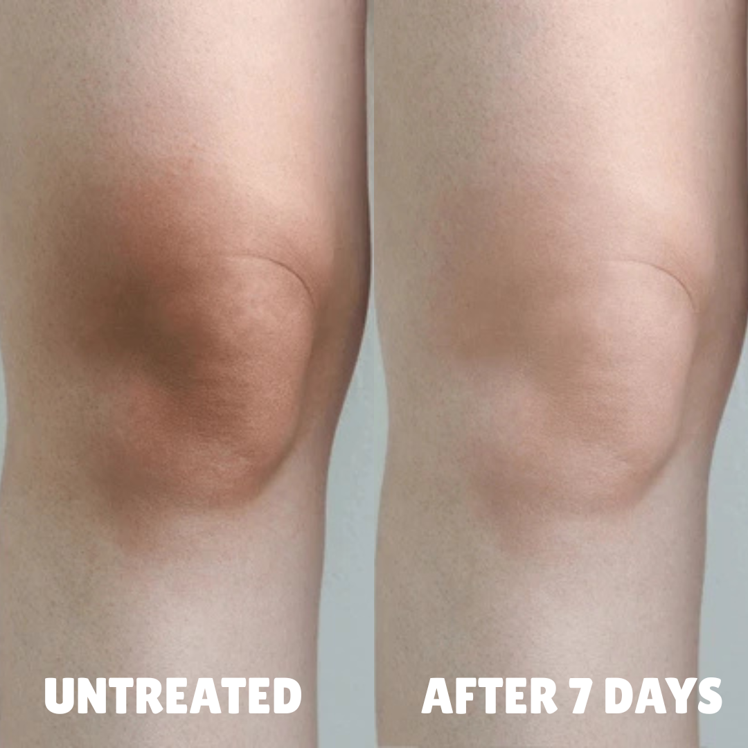 Cellular-Level Delivery Triple Acid Complex For Hyperpigmentation