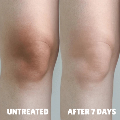 Cellular-Level Delivery Triple Acid Complex For Hyperpigmentation