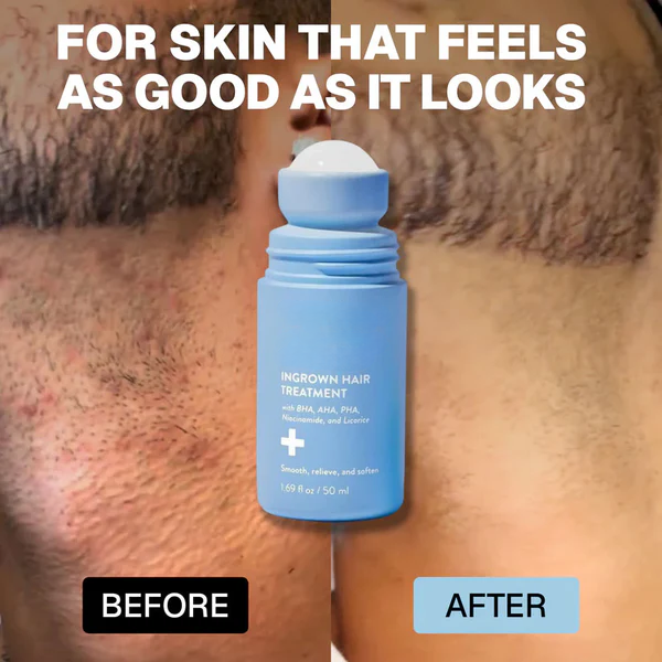 Tkhotpick: Smoothing Solution For Ingrown Hairs