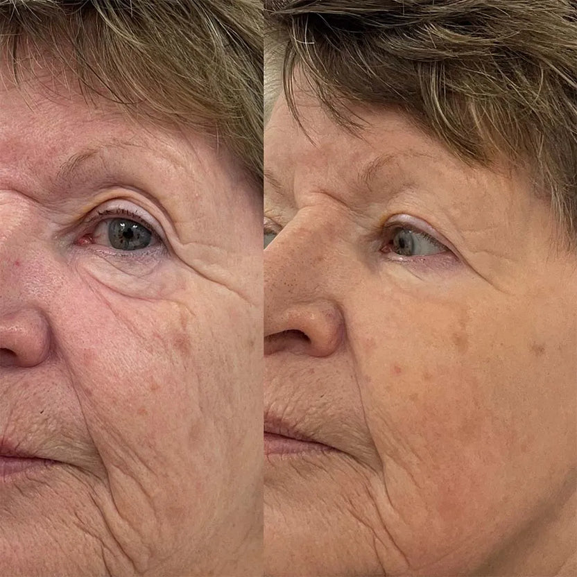 688b5c42efe2a55934466d26_exosomes-under-eyes-5.jpg