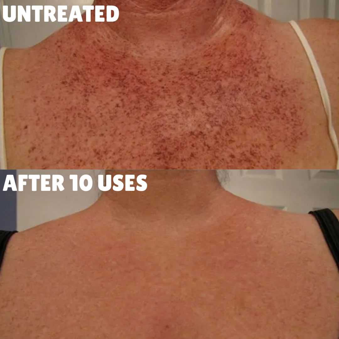 Cellular-Level Delivery Triple Acid Complex For Hyperpigmentation