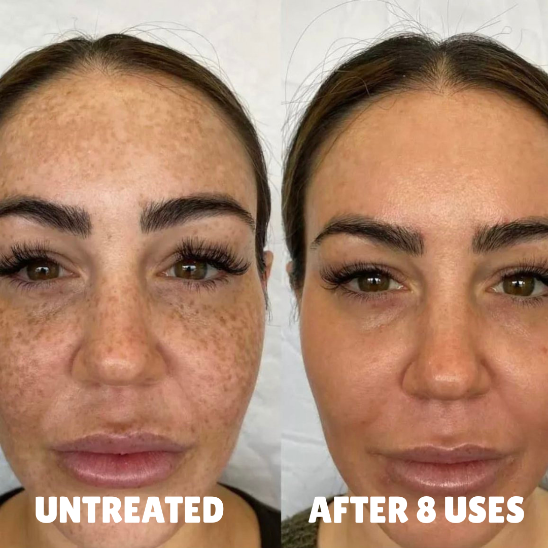Cellular-Level Delivery Triple Acid Complex For Hyperpigmentation