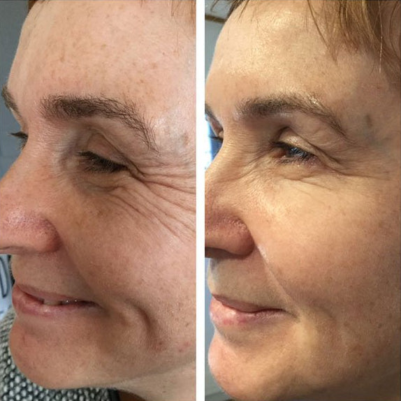 pt-193b0d8d6c67-wrinkles-before-after.jpg